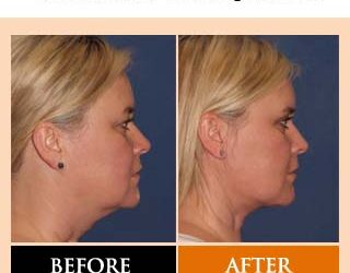 Facelift facts part 4 – frequently asked questions