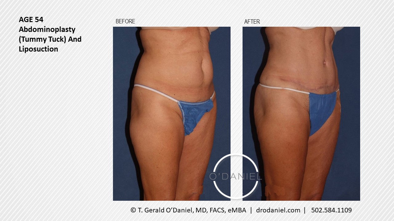 2020-08-20-54-Year-Old-Abdominoplasty-Tummy-Tuck-And-Liposuction-quarter-view