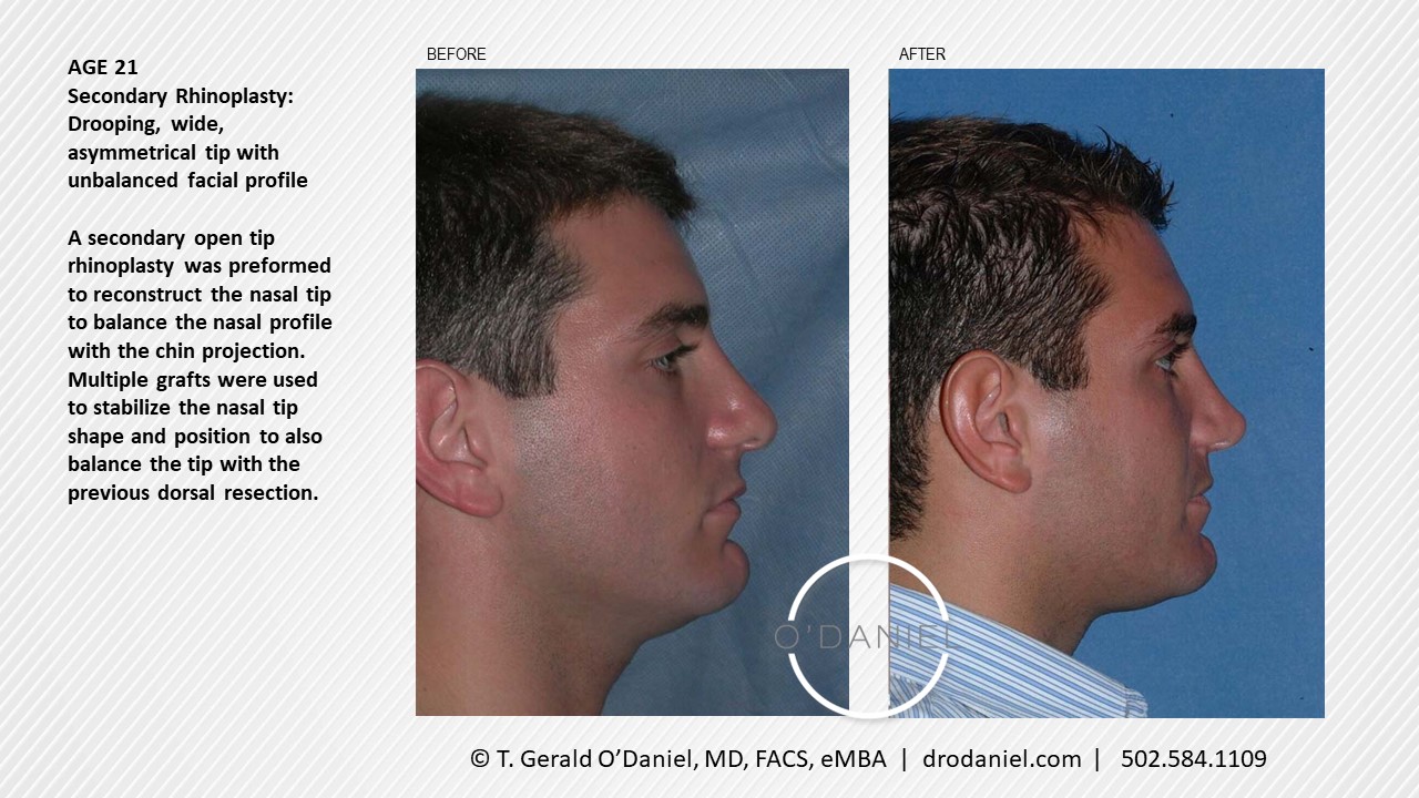 Revisional Rhinoplasty Case Study | Drooping, Wide, Asymmetrical Tip With  Unbalanced Facial Profile | Age - 21 