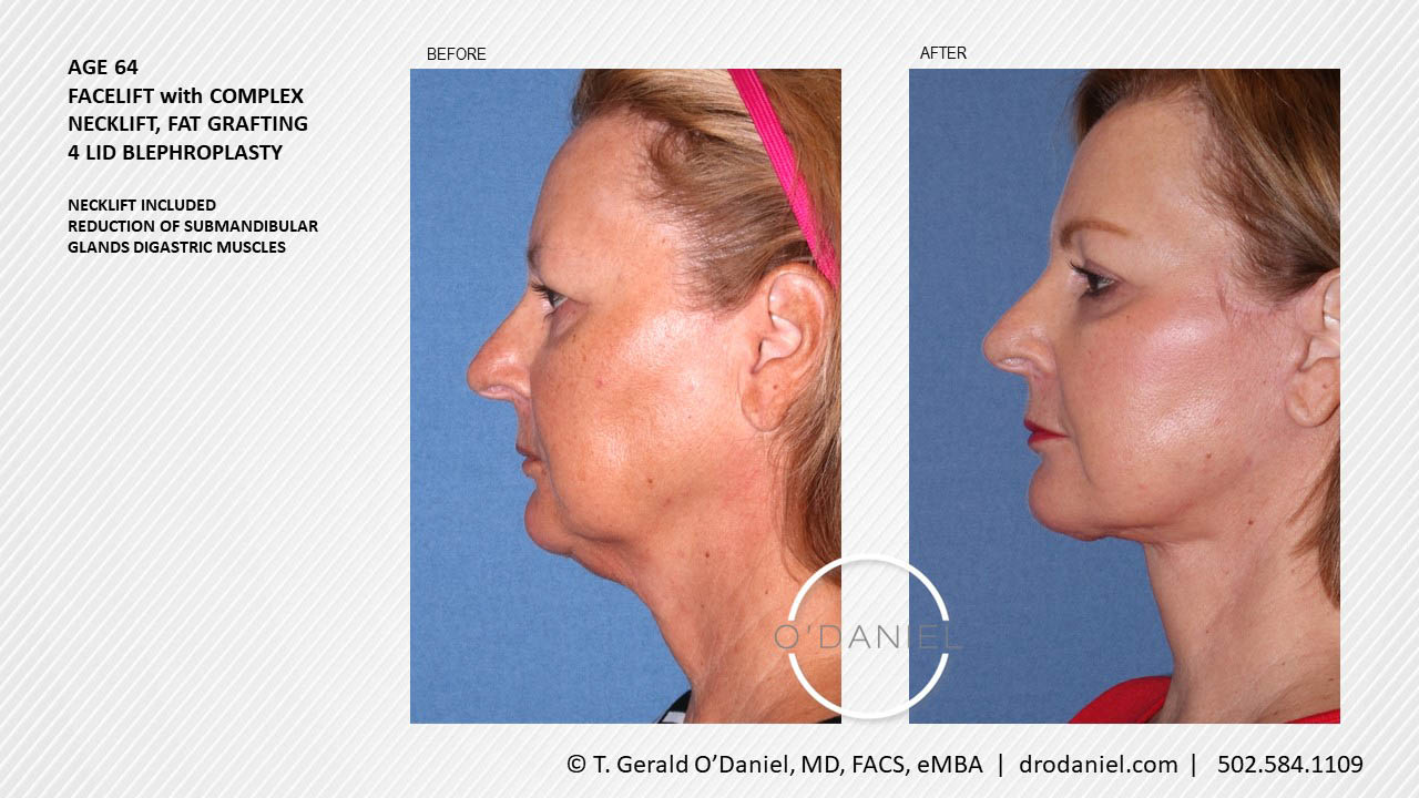 2020-7-9-Facelift-Patient-6-Age-64-side-views