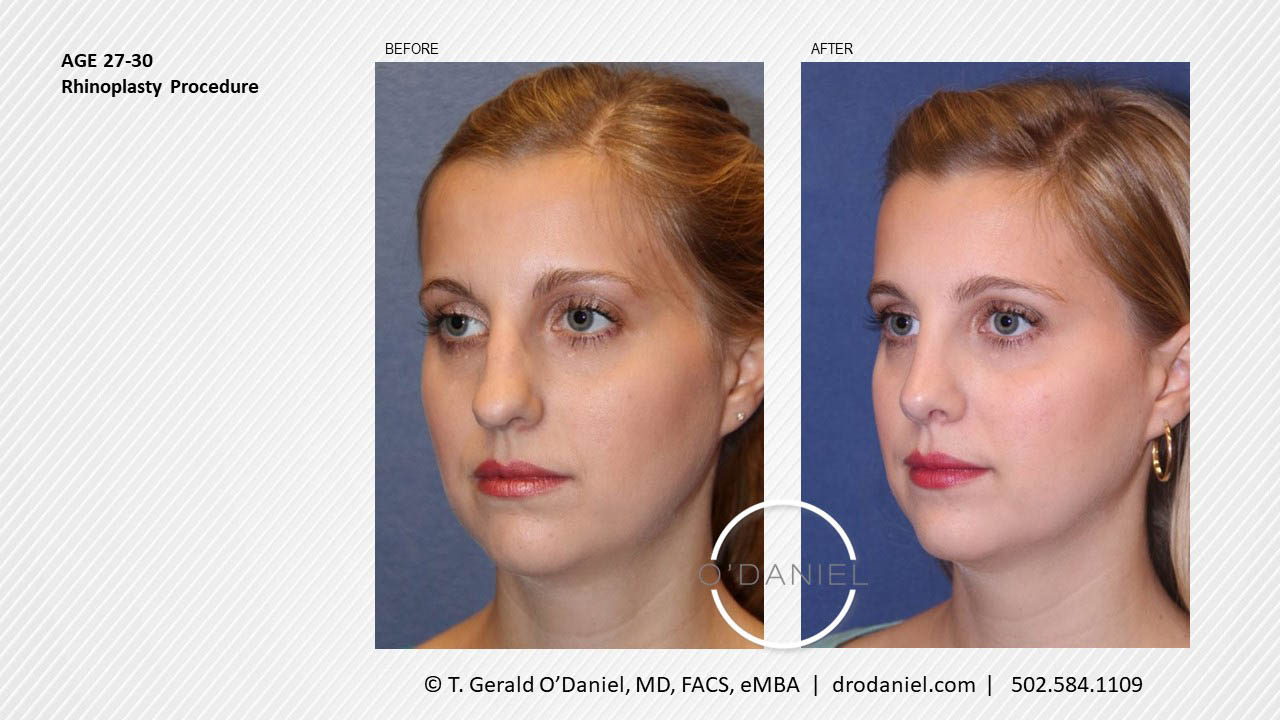rhinoplasty-louisville-case-study-before-and-after-1