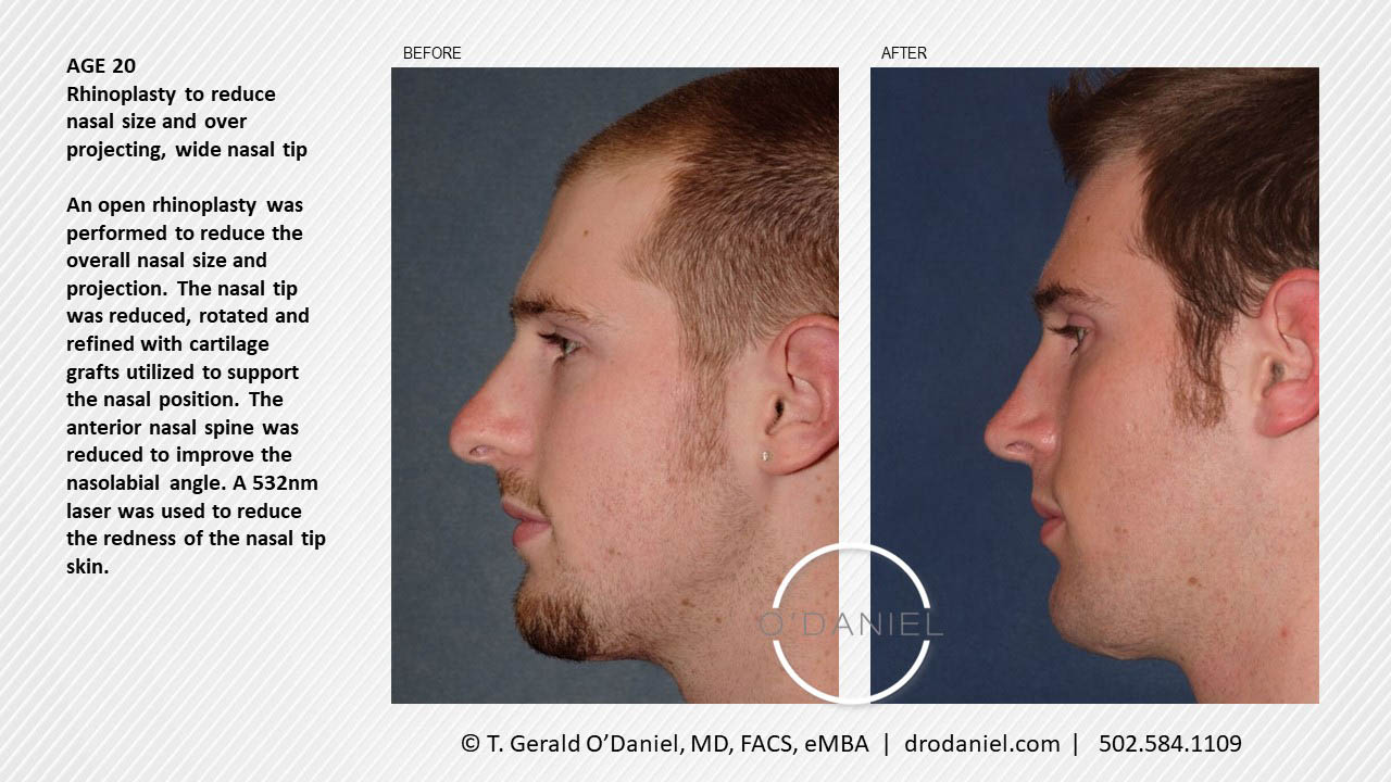 Rhinoplasty Case Study | Reduce Nasal Size & Over Projecting, Wide Nasal Tip  | Age - 20 