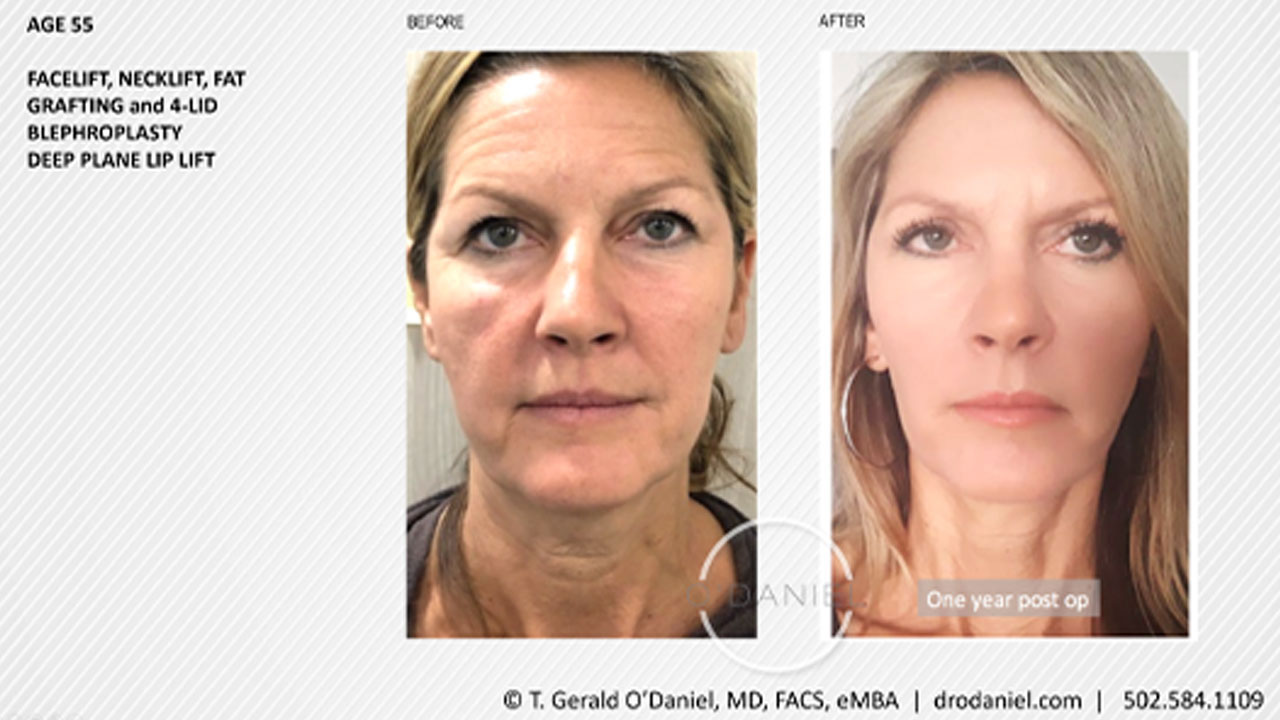 Facelift-Patient-Age-55-front-views